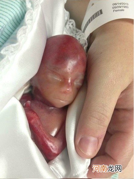 胎儿3天没动静死亡，孕妇还以为bb“懒”