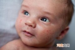 婴儿奶粉过敏的症状图片 宝宝奶粉过敏的识别和处理