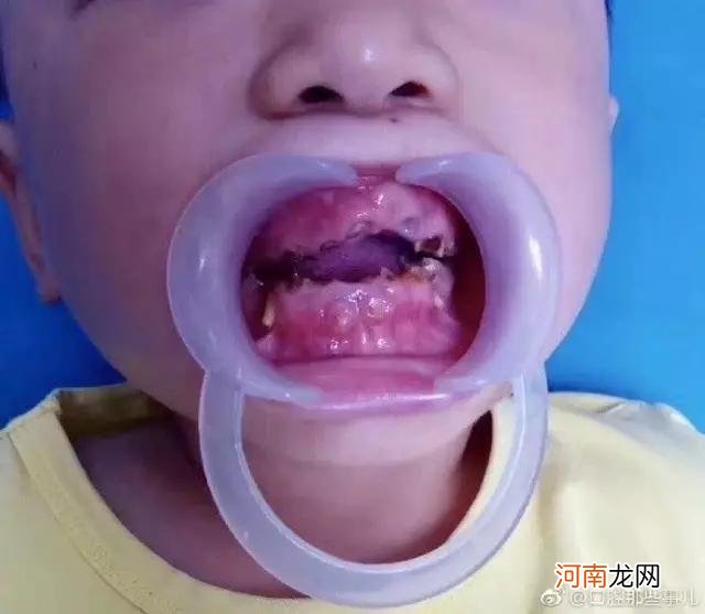 8岁儿童烂牙能不能拔 8岁大牙烂了是补还是拔