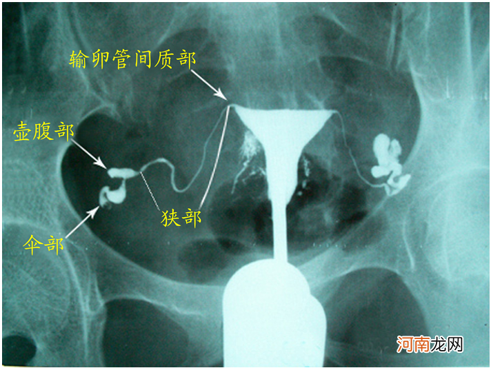 输卵管造影前后注意事项