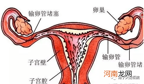 输卵管堵塞能怀孕吗