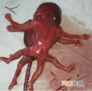 导致胎儿畸形的原因有哪些