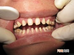 人的牙齿有多少颗 人的牙齿一共有多少颗