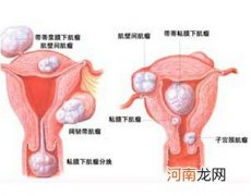 子宫内囊肿与胎儿争地盘