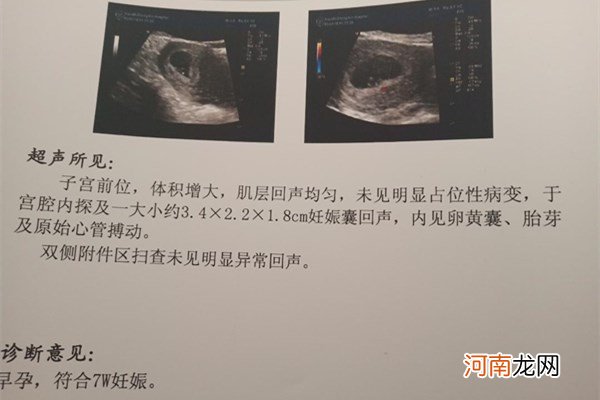 长孕囊和圆孕囊图片 是儿子还是闺女看孕囊一目了然