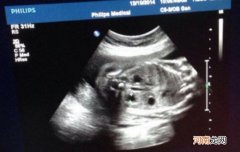 20周胎儿性别器官图片
