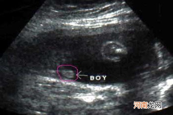 20周胎儿性别器官图片