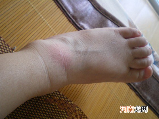 宝宝被蚊子咬了怎么消肿止痒