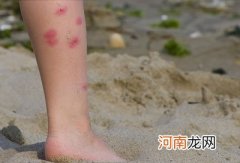 蚊子咬了怎么消肿止痒 蚊虫叮咬止痒妙方