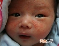 婴儿湿疹怎么治疗 婴儿湿疹的治疗方法