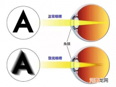 董氏针灸治疗近视散光