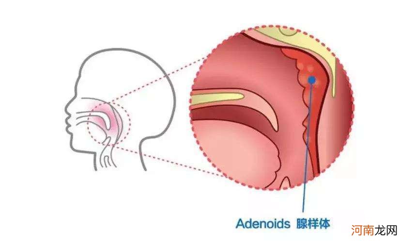 腺样体肥大一定要手术吗