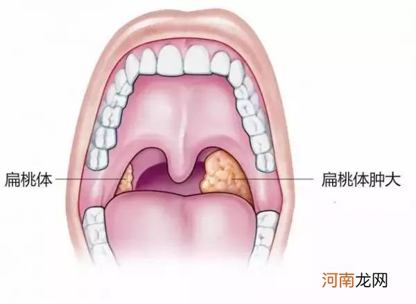 小孩扁桃体肥大打呼噜