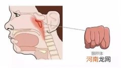 腺样体肥大最佳治疗期