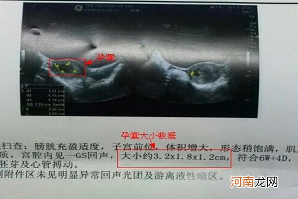 标准女孩孕囊 长是宽的二倍 据说95%的妈妈都中了