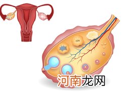 多囊没治疗自己怀孕了