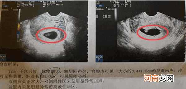 长孕囊和圆孕囊图片 孕囊一定是男孩的图片