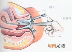 无痛人流2020价格