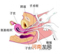 怀孕两个多月可以打掉吗?