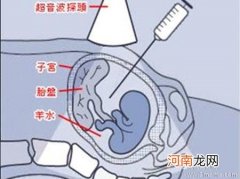 做羊水穿刺能报销吗