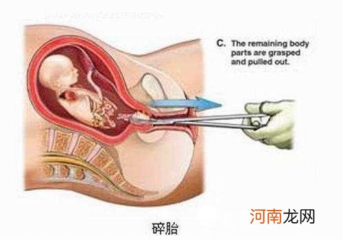 自己打胎的方法有哪些