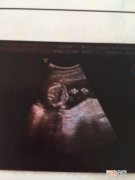 孕18周的胎儿是什么样子的 怀孕18周胎儿真实做彩超