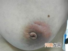 怀孕八个月后每天洗乳头可防乳腺炎