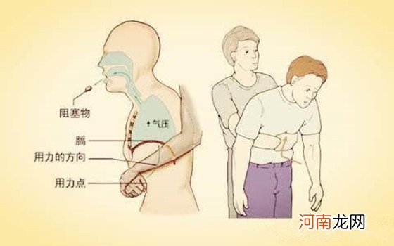 记住海姆立克急救法有哪些步骤 关键时刻能救命