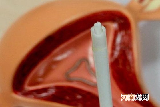 节育环可以终身不取吗 这几个小问题你一定要了解