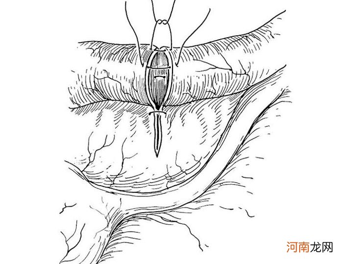 结扎切断的还能接上吗 女人结扎剪断还能接上吗