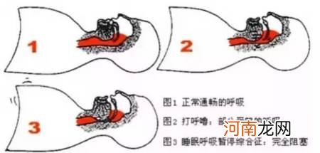 他人打呼噜的解决办法