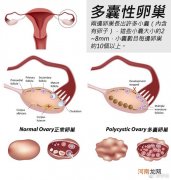 多囊是怎么得来的 多囊卵巢症是怎么引起的
