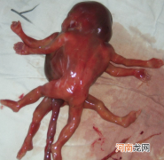孕期出血保胎成功要防胎儿畸形