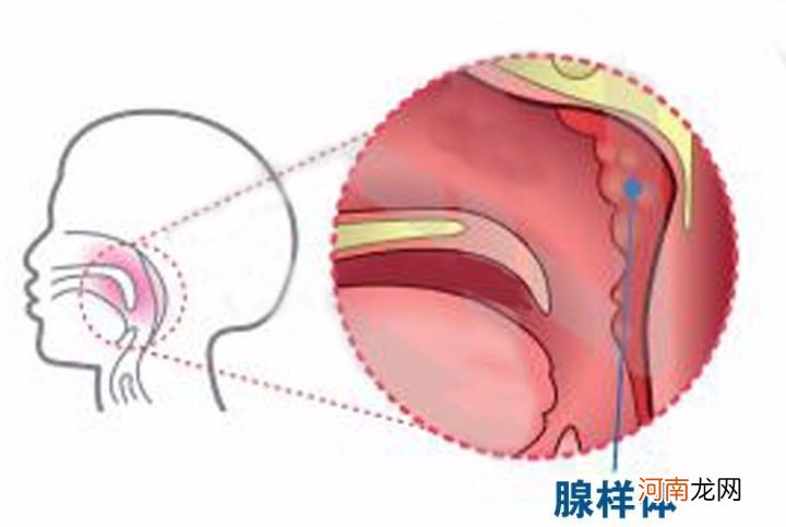 腺样体肥大