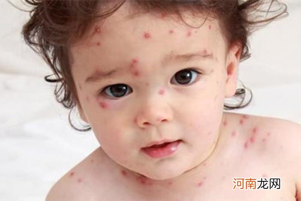 小孩急性荨麻疹怎么办 很多宝妈用错方法越治越病