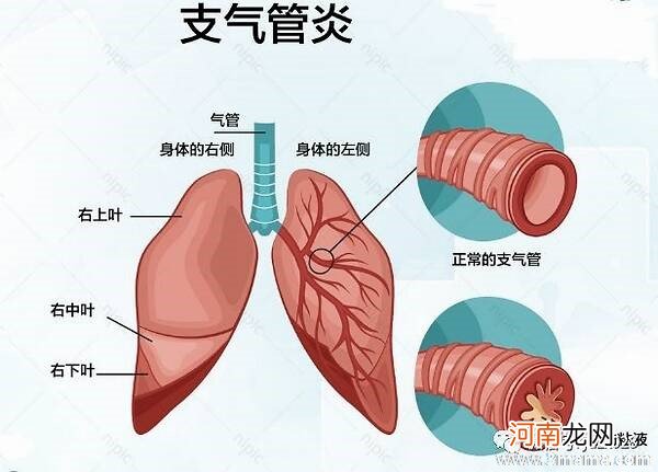 孕晚期支气管炎怎么办