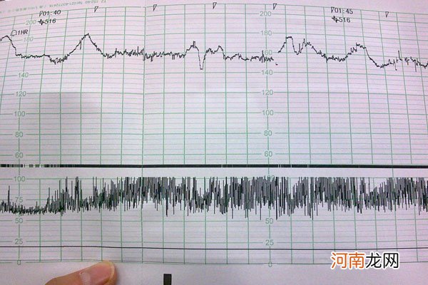 胎心监护到底有什么作用