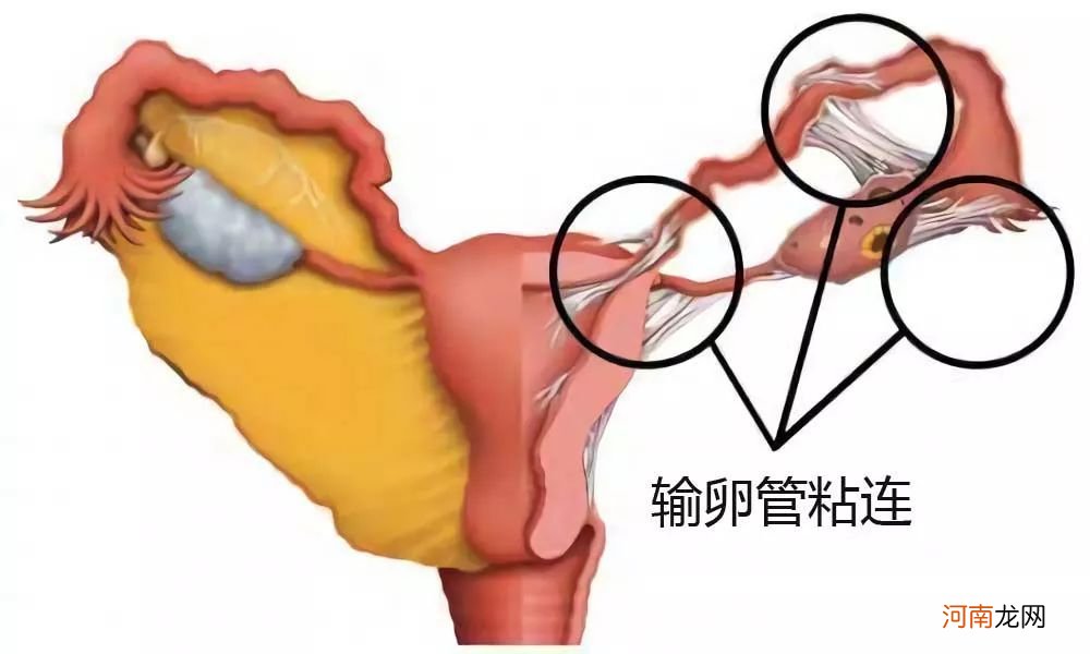 输卵管粘连能自然怀孕吗