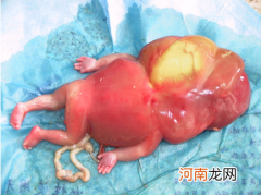 过半胎儿畸形可在怀孕三个月查出