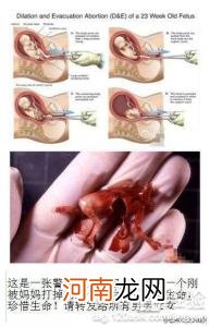 怀孕23周引产过程