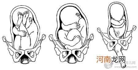 胎位不正只能选择剖腹产吗？