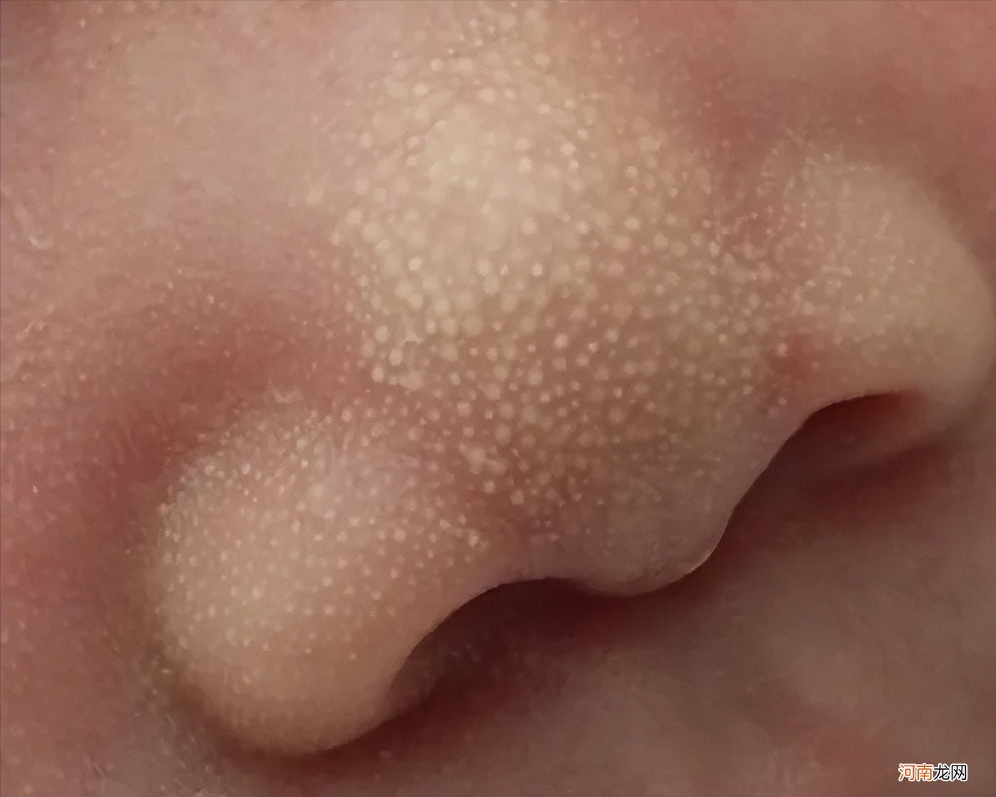 宝宝皮肤红红的，是过敏吗？带了6个孩子总结5个关于湿疹的经验