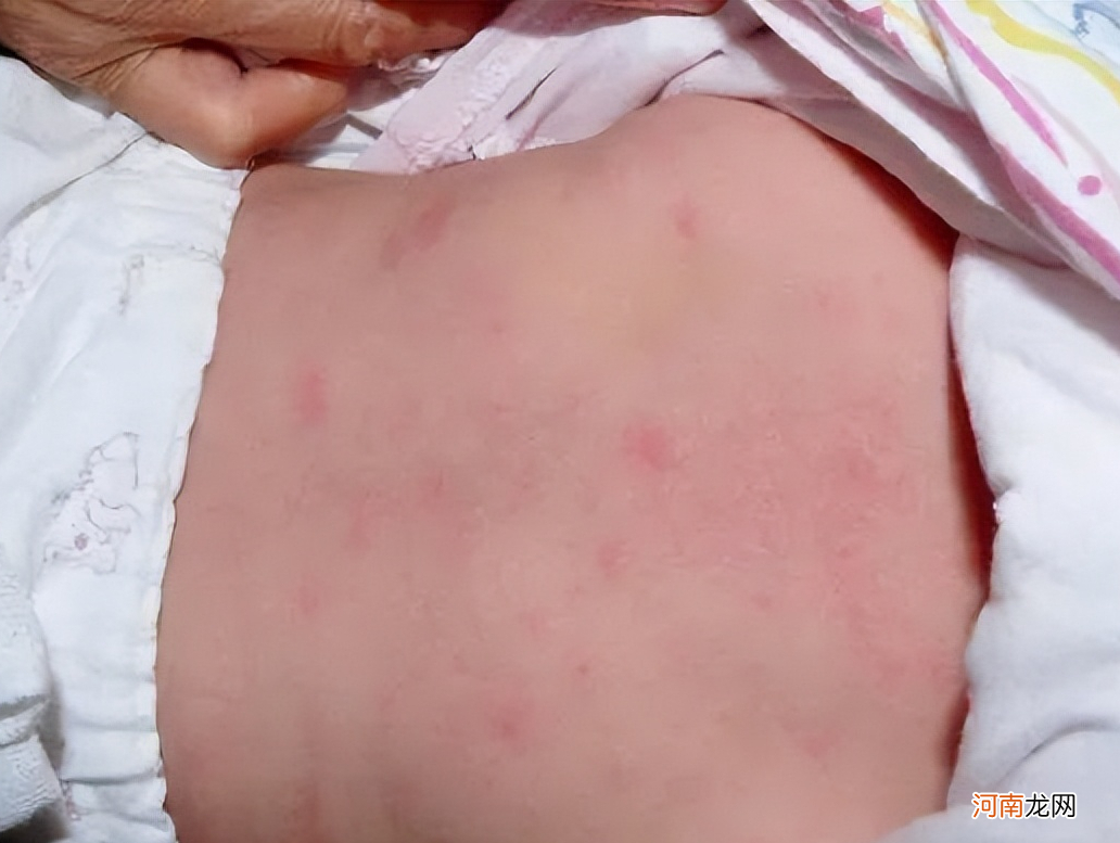 宝宝皮肤红红的，是过敏吗？带了6个孩子总结5个关于湿疹的经验