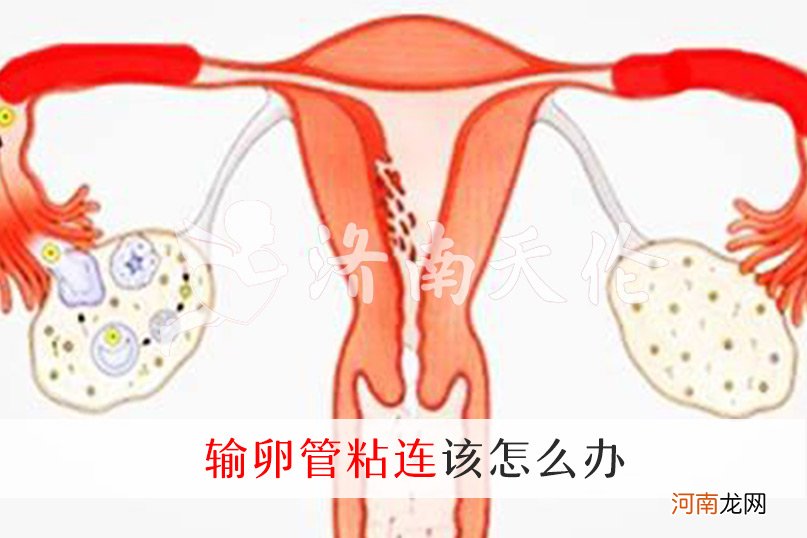 输卵管粘连图