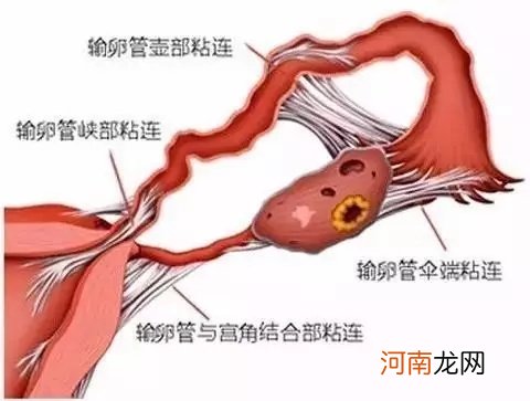 双侧输卵管伞端粘连严重吗