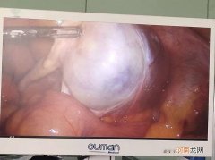 多囊卵巢可以做手术去掉吗?