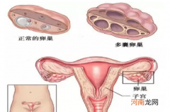 多囊严重吗可以怀孕吗