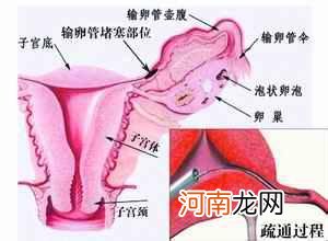 输卵管导丝介入后遗症