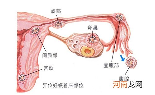 没结婚输卵管为什么会堵住