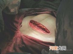 年轻妈妈剖腹产视频全过程 - 剖腹产